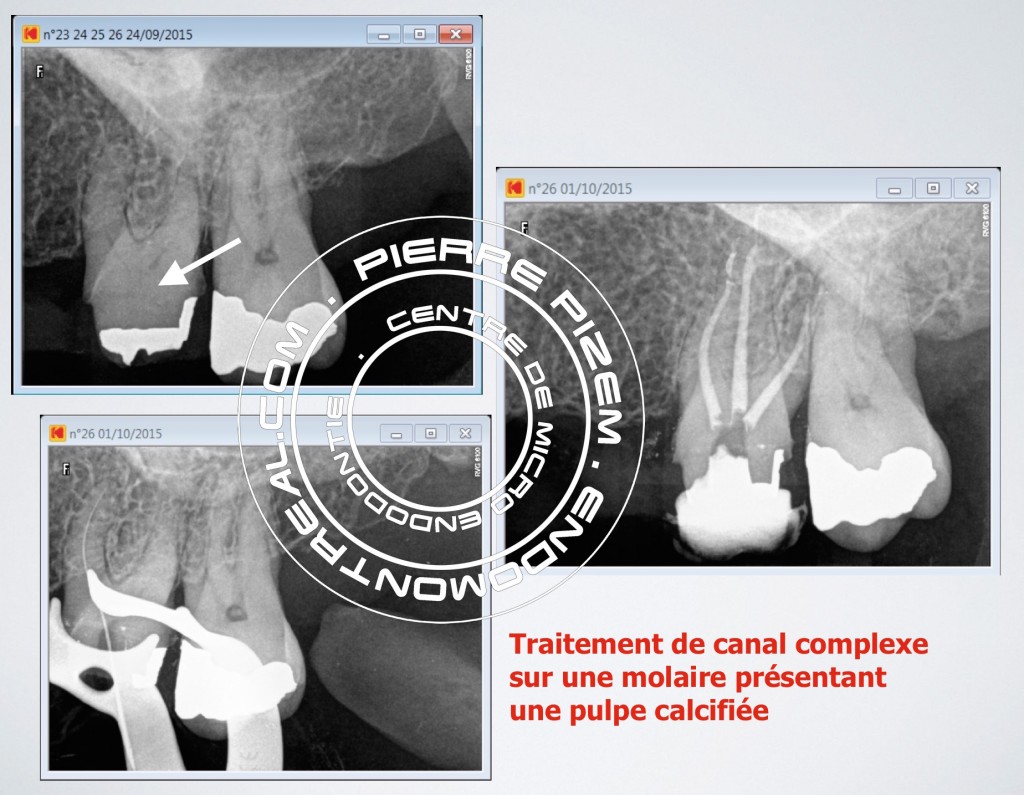 Traitement de canal microchirurgical