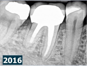 Root canal procedure and periradicular tissue healing 2016-02-21