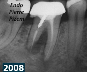 Root canal procedure and periradicular tissu healing 2016-02-21