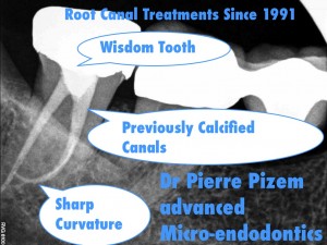 Advanced Root Canal Procedure on a Tooth Presenting with a severe Root Canal Curvature