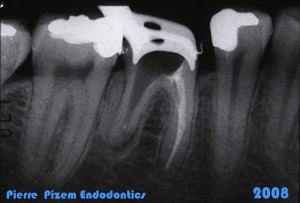 Dental Operative Microscope and Retreatment, Orthograde MTA plugs and root repairs, Root Canal Treatment Per-Therapy (1) 