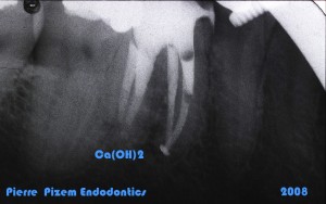 Dental Operative Microscope and Retreatment, Orthograde MTA plugs and root repairs, Root Canal Treatment Per-Therapy (2) 