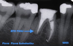 Dental Operative Microscope and Retreatment, Orthograde MTA plugs and root repairs, Root Canal Treatment Per-Therapy (3) 