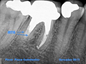 Dental Operative Microscope and Retreatment, Orthograde MTA plugs and root repairs, Root Canal Treatment Post-Therapy