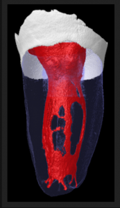 High level of difficulty root canal treatment to perform in a C shape canal, a root canal anatomy variation. Image from: "The Root Canal anatomy project"