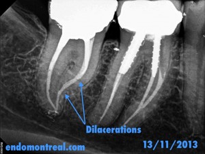 S Shape Root Canal Procedure