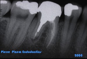 Dental Operative Microscope and Retreatment, Orthograde MTA plugs and root repairs, Root Canal Treatment Pre-Therapy 