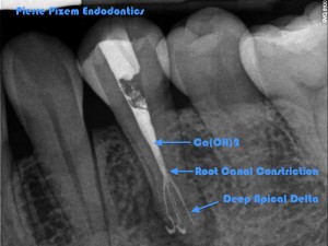 Anatomical Variation and root canal Treatment on 35  Ca(OH)2