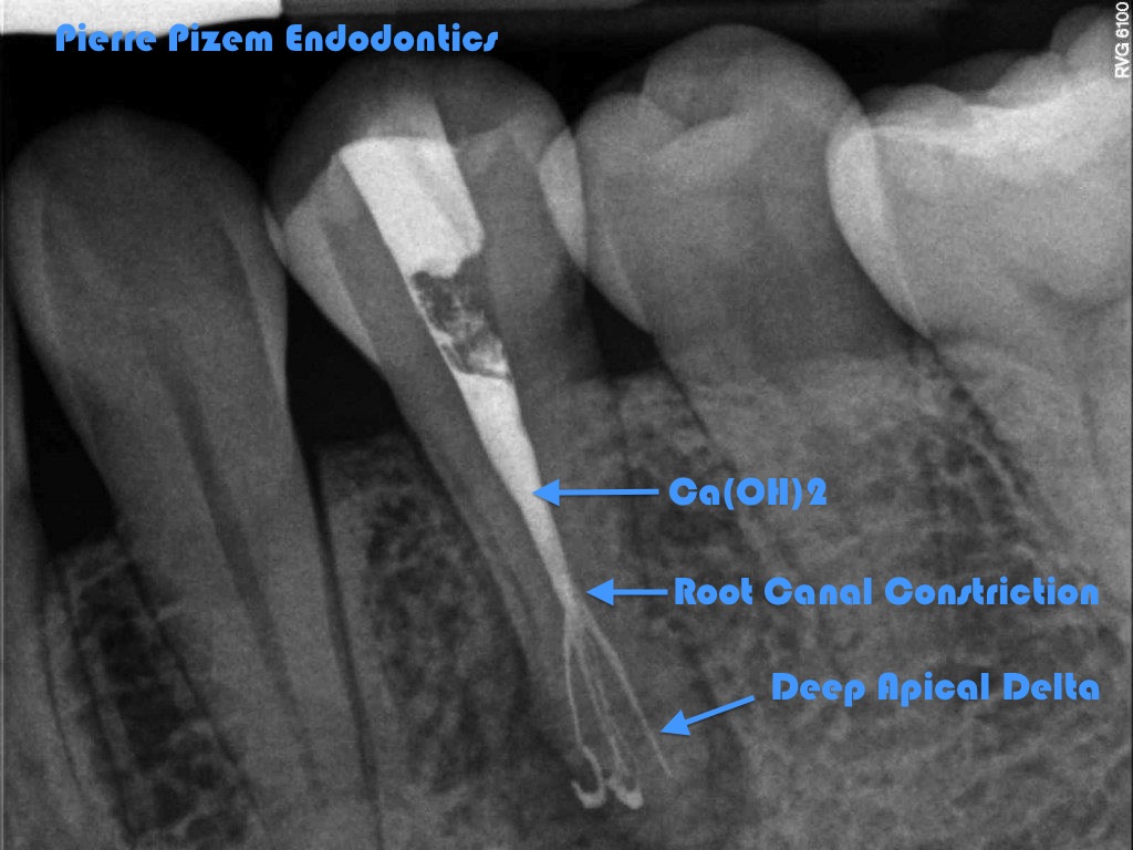 molar root canals