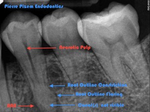Anatomical variation 35 and root canal treatment Pre op