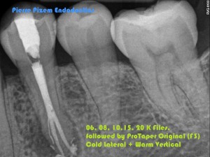 Anatomical Variation and Root Canal Treatment 