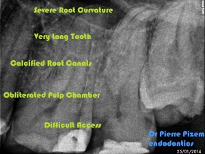 Root Canal with S Curvature Pre-therapy 
