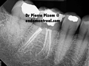 Root Canal Treatment on Calcified Molar Post Therapy 46969-14