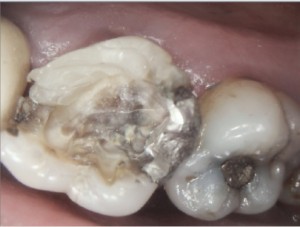 Root canal therapy on maxillary molar Per operative picture 2015-08-27 1 