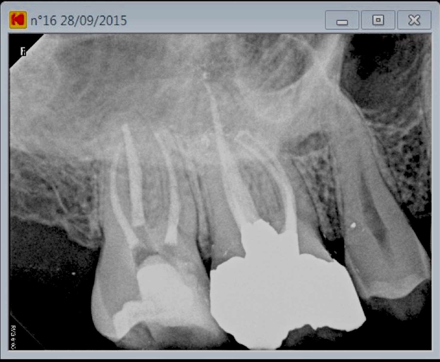molar root canals