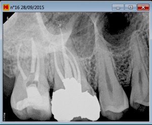 second mesiovestibular post root canal treatment B