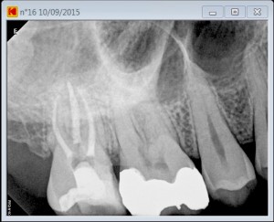 second mesiovestibular pre root canal treatment