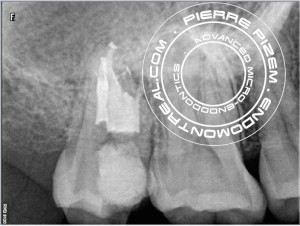 C shape 17 post operative