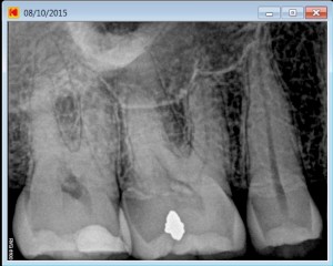 severe root canal curvature 17 pre operative