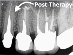 24 Pre Root Canal Therapy