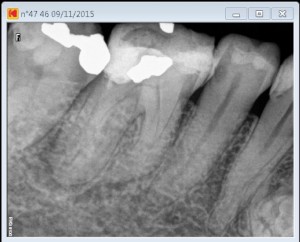 46 dilaceration pre root canal therapy