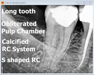 47 calcified tooth root canal procedure pre therapy 2016-01-13 