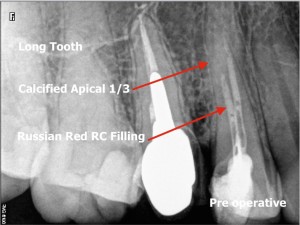 Russian red removal and calcified root canal procedure pre operative