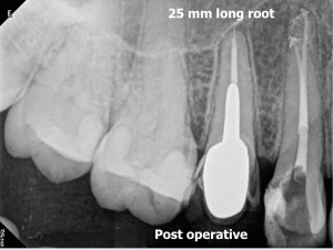 Russian red removal and calcified root canal procedure post operative