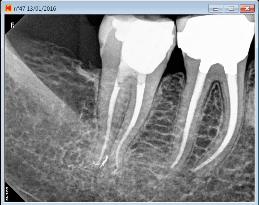 molar root canals