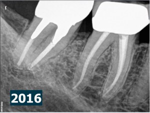 47 endodontic revision j shape post therapy