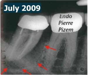 47 endodontic revision j shape pre therapy