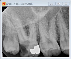 17 second palatal canal pre operative
