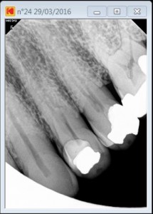 Tooth 24 long calcified 3 rooted tooth pre operative 2016-03-29