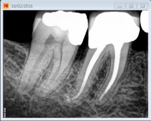 47 Apical delta mag Pre Op 2016-03-18