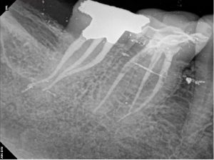 47 root canal treatment post therapy C 2016-04-18