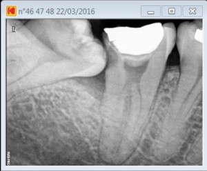 Root cana procedure on a 47 C shape pre operative