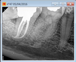 Root cana procedure on a 47 C shape post operative