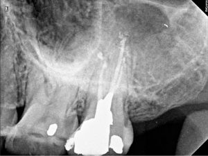 Root canal treatment procedure on 27 taurodontia and calcified B 2016-06-07