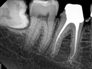 47 Root Canal Treatment on a Calcified molar D