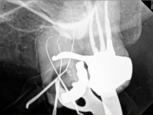 calcified-curved-and-long-canals-26b-2016-12-03 first instruments