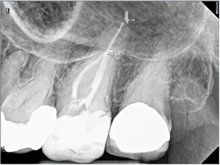 factors affecting the level of difficulty of this endodontic procedure on a long remote and heavily calcified second maxillary molar 27 irreversible