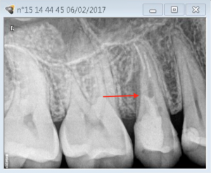 15 lateral canal management A 2017-04-27