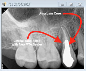 Root canal revision procedure on tooth 15 lateral canal management E