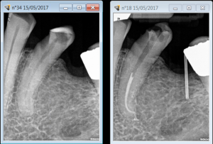 A challenging Root canal treatment procedure 