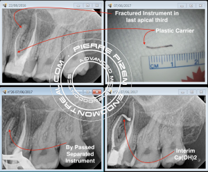 26 plastic carrier Retrieval and Separated Instrument By pass 2017-06-08