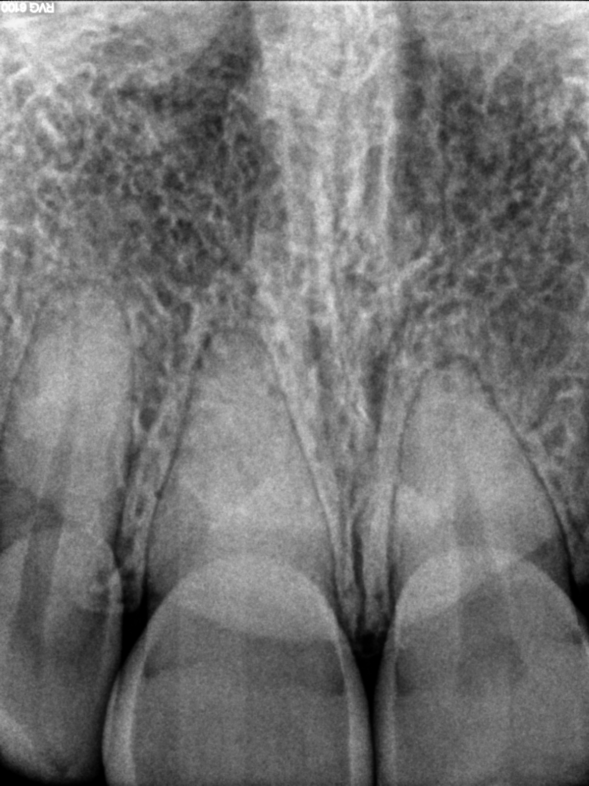 Calcified-Tooth-No-112