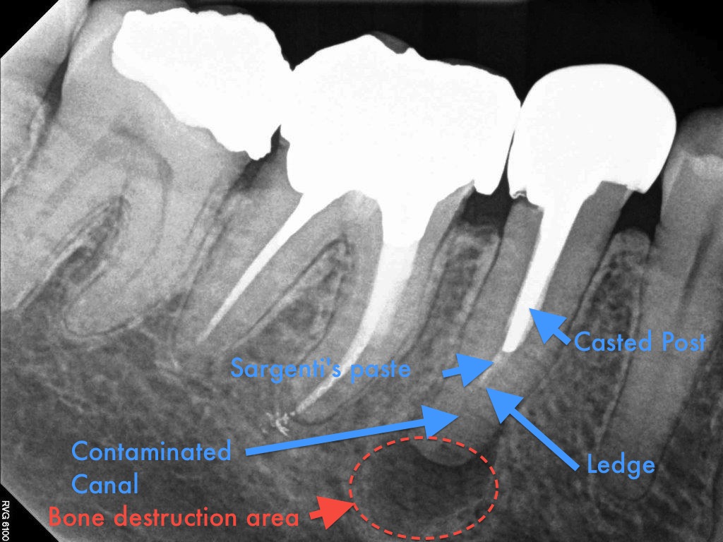Post removal and endodontic revision