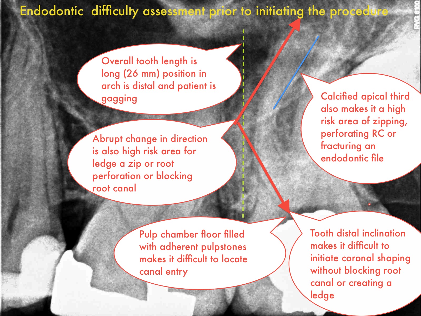 A root canal procedure assessed at a Class 3 level of difficulty and risk