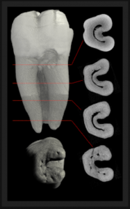 High level of difficulty root canal treatment to perform in a C shape canal, a root canal anatomy variation. Image from: "The Root Canal anatomy project"