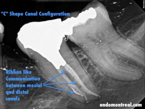 Root canal filling and Nayyar Core build up
